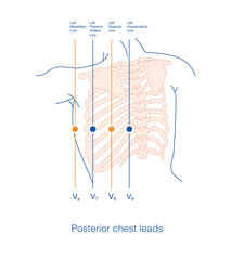 Place the surface electrocardiogram exploration electrode at the specified anatomical position on the left back to form a posterior lead consisting of V7-V9 leads. - obrazy, fototapety, plakaty