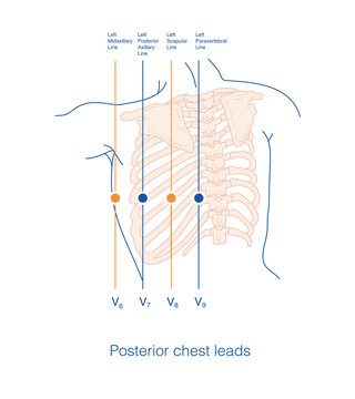 Place the surface electrocardiogram exploration electrode at the specified anatomical position on the left back to form a posterior lead consisting of V7-V9 leads.