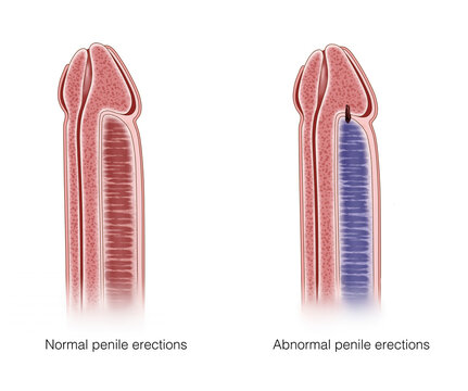 When the penis vein is blocked, it will lead to Priapism of the penis. If the penis is erected for a long time (more than 4 hours), the patient will have pain and other symptoms.