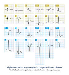 Different patients with congenital heart disease have different ECG patterns for right ventricular hypertrophy, depending on diastole overloaded or systole overloaded.