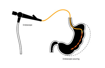 Endoscopic sleeve gastroplasty