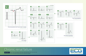 Common ECG changes in chronic renal insufficiency include left ventricular hypertrophy, left atrial abnormality, poor R wave progression and ST-T changes.