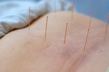 doctor sticks needles into the human body on the acupuncture. Traditional Chinese Medicine....