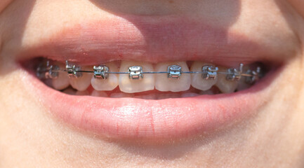 Teeth with braces of a smiling girl. Macro