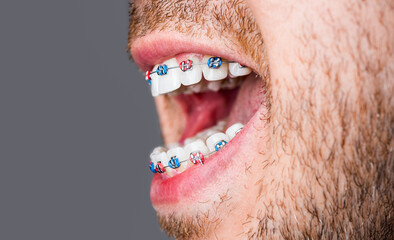 Bracket system in smiling mouth, macro photo teeth, close-up lips, macro shot, dentist. Man braces....