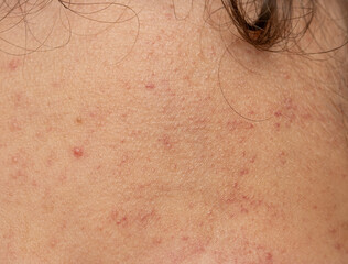 allergic red rash on the face.