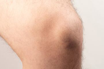 Dark color bruise on knee