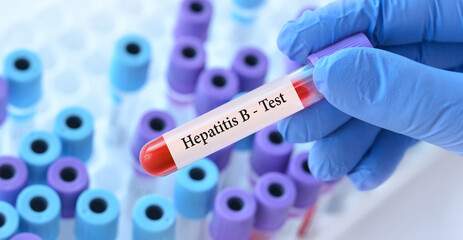 The doctor holds a test blood sample tube with hepatitis B virus (HBV) test on the background of...