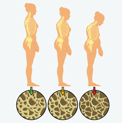 Osteoporosis - the progression of osteoporosis and vertebral fractures as a woman ages.