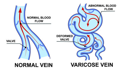 Normal vein. Varicose vein. Blood flow. Vector illustration. Healthcare illustration. 
