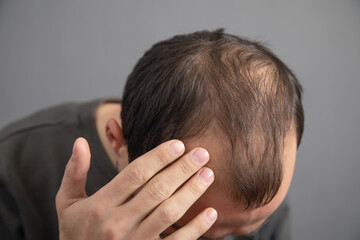 Caucasian man. Hair loss problem