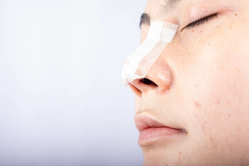Portrait of a woman with her nose heavily bandaged after plastic surgery.