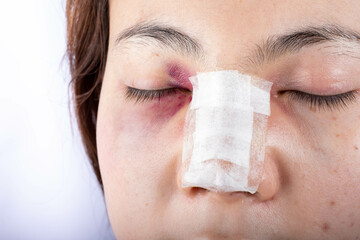Portrait of a woman with her nose heavily bandaged after plastic surgery.