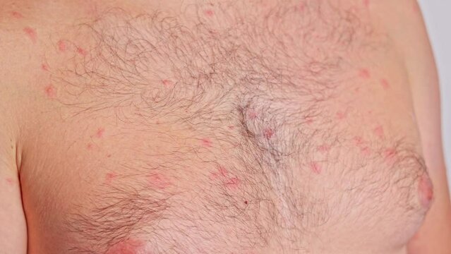 Man with acne, red spots, skin disease. Varicella or Herpes Zoster concept