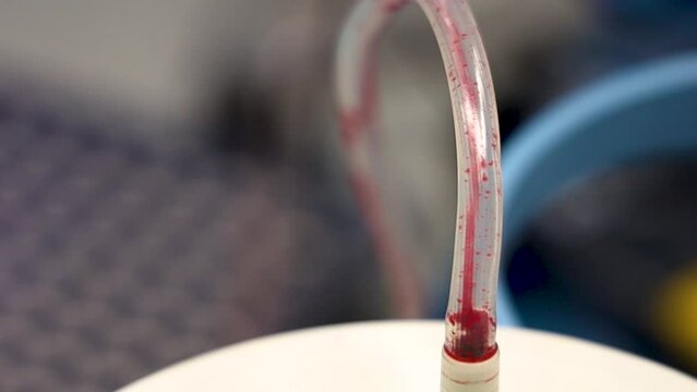 4K hyper close up footage of blood discharge through blood tube from patient's body during real operation stock video.