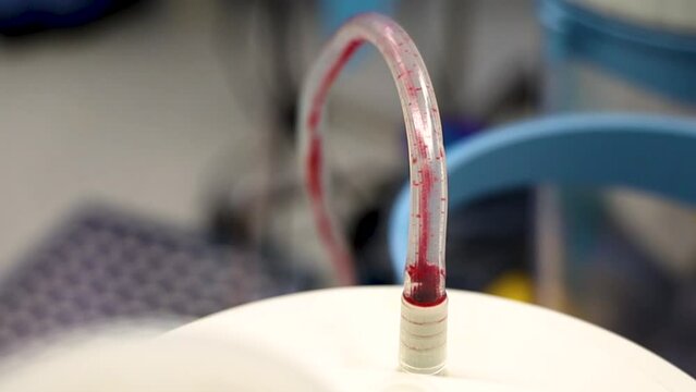 4K hyper close up footage of blood discharge through blood tube from patient's body during real operation stock video.