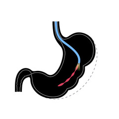 Endoscopic sleeve gastroplasty