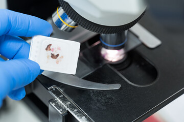 Scientist wear blue glove holding parafin human tissue block and out of focus microscope.Biopsy in the laboratory of cancer researchMedical patholology and cytology laboratory technology concept.
