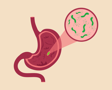 Stomach disease Helicobacter Pilori disease in human Stomach