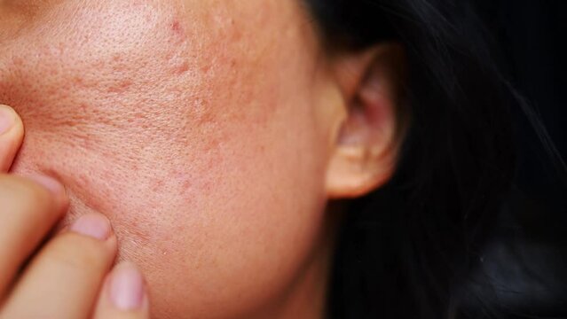 acne scars on the cheek on the face of women the reason for this is that the overlay on the skin breaks down and leaves a hole, narrow and deep use for cream or cosmetic product
