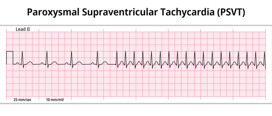 ECG Paroxysmal Supraventricular Tachycardia (PSVT) - 8 Second ECG Paper - Electrocardiogram Vector Medical Illustration