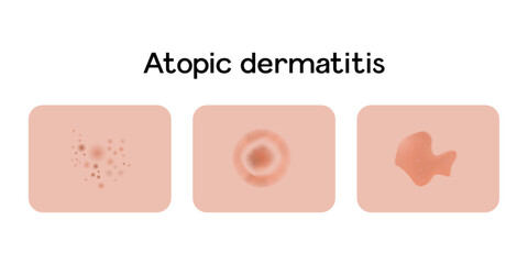 Atopic dermatitis examples vector illustration design, medical problems
