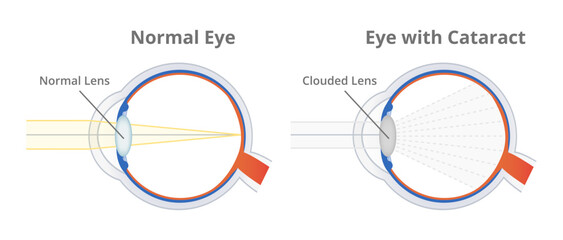 Anatomical vector scheme or illustration of a normal healthy eye and eye with cataract or cataract eye isolated on white. Cloudy area in the lens, clouding of the lens. Eye vision disorder. - obrazy, fototapety, plakaty