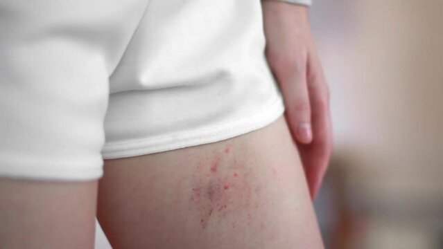A woman was bitten by an insect on the leg close-up. Consequences of insect bites. Allergic reaction from the bite.