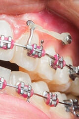 Dental Braces Accessories: rubber bands or elastics with braces