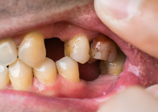 Missing teeth and dental problems in a caucasian man close-up