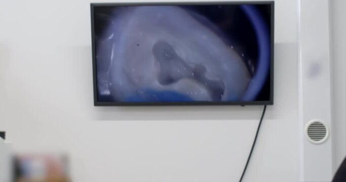 A dentist treats a person's tooth, uses a medical magnifying device to enlarge, an enlarged image is displayed on a large monitor