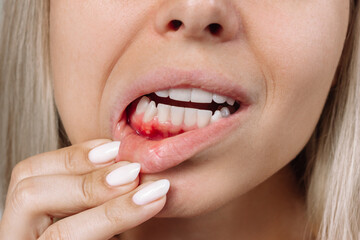 Ulcerative stomatitis on the gums. Gum inflammation. Close up of young blonde woman showing red...