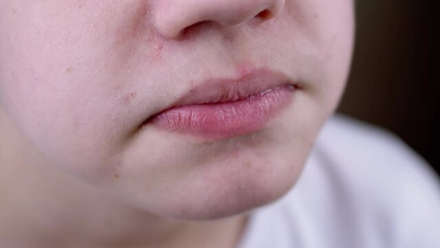 Close up, Child Chews Chewing Gum on a Blurred Background. Portrait, part of face, lips, cheek, nose teen with acne. Jaw movement, salivation, lip licking. Teeth cleaning. Dentistry. Lifestyle.
