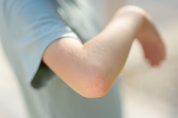 Dermatitis on the skin of the boy's elbow joint. Allergic reaction on the child skin due to...