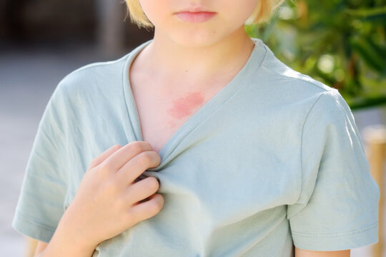 Mark On The Skin Of Chest Of Eight Years Old Child. Hemangioma Is A Red Birthmark From Blood Vessels On The Skin, Benign Tumor.