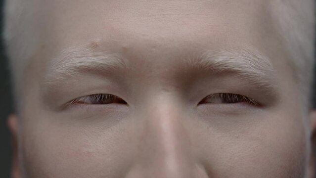 Close up portrait of the eye of an Asian albino guy. Genetic mutation of the pigment. Lack of melanin, unusual appearance. A colorless male looks into the camera. Twitching eyes because of Nystagmus