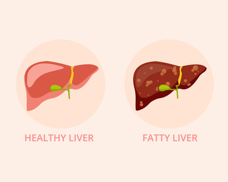 Fatty liver and healthy liver Healthy and damaged human internal organ
