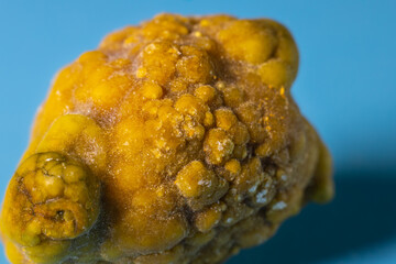 Gallstones,multiple cholesterol stone in gallbladder with cholecystitis. Gallbladder disease, stone...