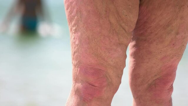 Close up obesed wrinkled legs of retired lady on the beach. Cellulite and varicosis.