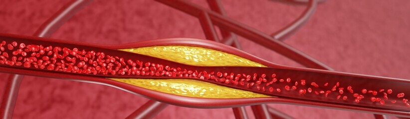 Hyperlipidemia. Blocked artery concept and human blood vessel as a disease with cholesterol fat buildup clogging. Clogged arteries, Cholesterol plaque in the artery. 3D Rendering
