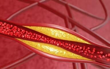 Hyperlipidemia. Blocked artery concept and human blood vessel as a disease with cholesterol fat buildup clogging. Clogged arteries, Cholesterol plaque in the artery. 3D Rendering