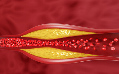 Hyperlipidemia . Blocked artery concept and human blood vessel as a disease with cholesterol fat buildup clogging. Clogged arteries, Cholesterol plaque in the artery. 3D Rendering
