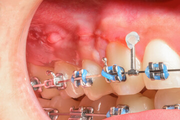 Close-up image capturing the consequences of using tight rubber bands or elastics on gums. Visible...