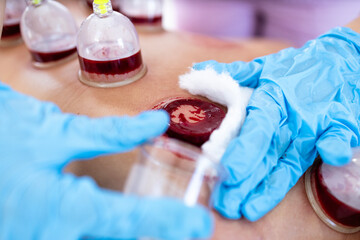 Hijama expert removing suction cup and cleaning blood after treatment.