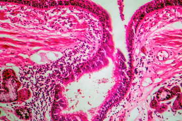 Photomicrograph of bronchial epithelial squamous metaplasia
