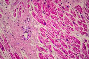 Photomicrograph of myocardial infarction