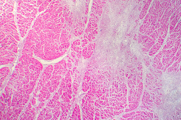 Photomicrograph of myocardial infarction