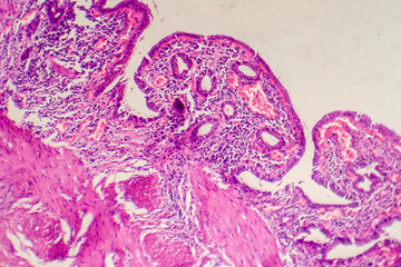 Photomicrograph of chronic cholecystitis