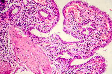 Photomicrograph of chronic cholecystitis