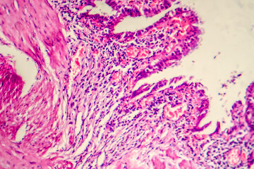 Photomicrograph of chronic cholecystitis